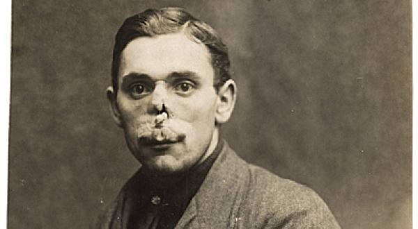 Il risultato di vecchie procedure di chirurgia plastica