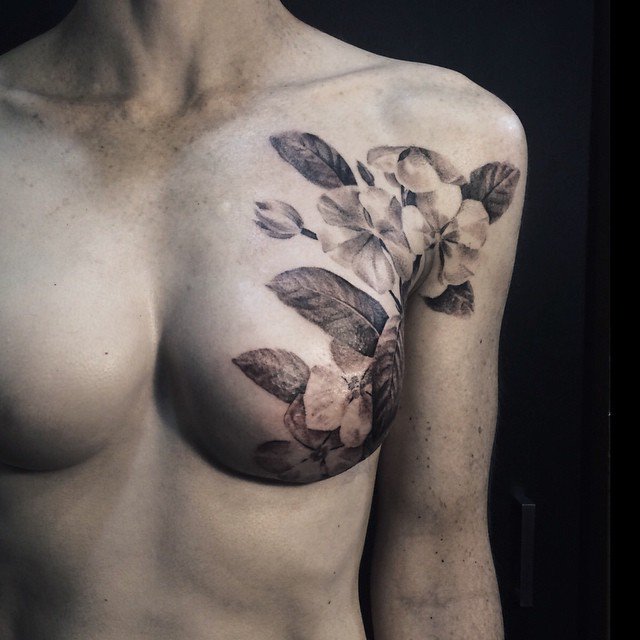 David Allen - Mastectomy