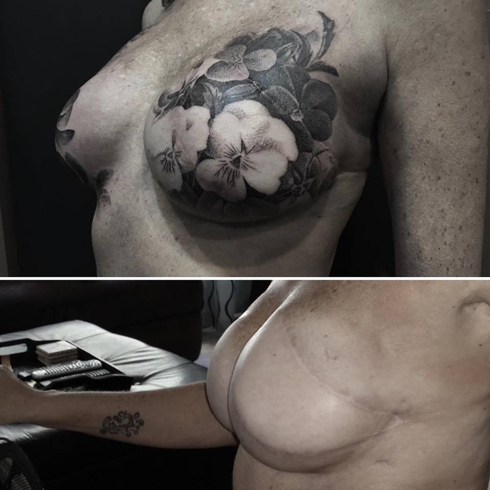 David Allen - Mastectomy