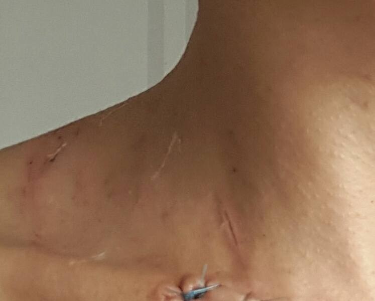 Gemiliana Assorgia - i segni dell'aggressione avvenuta a Saigon (Vietnam)