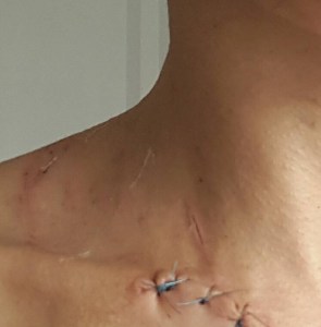 Gemiliana Assorgia - i segni dell'aggressione avvenuta a Saigon (Vietnam)