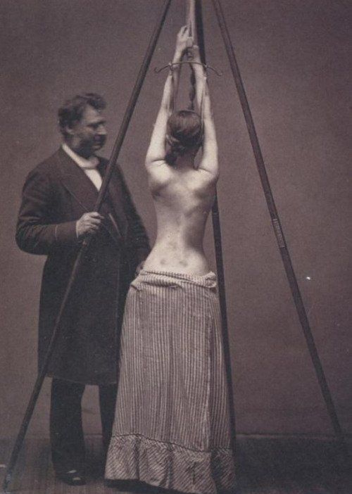 Medico ispeziona una donna che soffre di scoliosi durante il 19 ° secolo